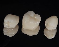 Up-close images of three different, non-metal dental crowns 