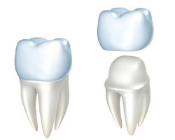 Dental crowns in Weyauwega
