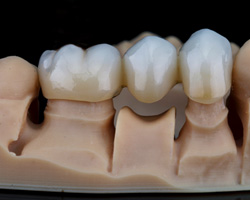 A traditional dental bridge 