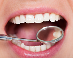 Closeup of smile during dental treatment