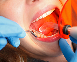 Closeup of teeth during dental treatment