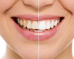 Closeup smile half before and half after teeth whitening