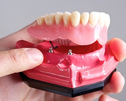 Model of implant supported denture