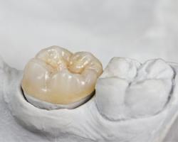 A dental crown sitting in a casting mold.