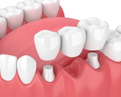 A diagram of a dental bridge.