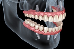 Implant dentures in Weyauwega