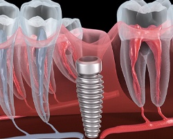 Failed dental implant in Weyauwega