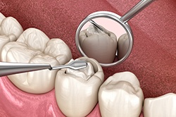 a computer illustration showing a tooth being filled 
