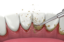 Illustration of scaling and root planing for lower teeth