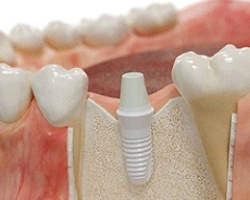 A ceramic dental implant in Weyauwega