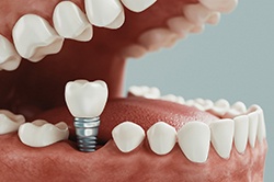 Diagram showing a single tooth dental implant in Weyauwega being placed