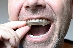 Closeup of man putting in mouthguard to protect his dental implants in Weyauwega