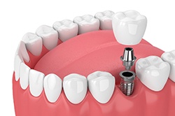 Single tooth dental implants in Weyauwega