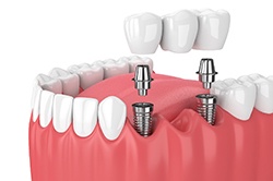Diagram of implant bridge replacing multiple missing teeth in Weyauwega