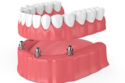 Diagram of implant dentures in Weyauwega