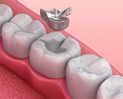 Digital image of a silver filling being placed into a cavity-filled tooth