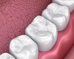 Digital image of a tooth-colored filling covering a cavity-filled tooth