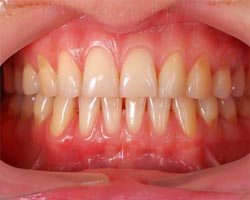 Close up of gums