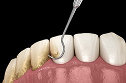 Illustration of scaling and root planing performed on the fronts of teeth