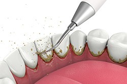 Illustration of plaque and tartar being removed from backs of teeth
