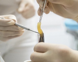 Two dental professionals extracting the PRF to place on a patient’s surgical site