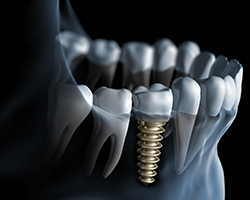 Animation of implant supported dental crown