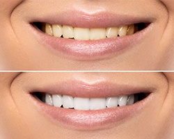 before and after teeth whitening