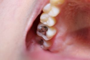 amalgam fillings