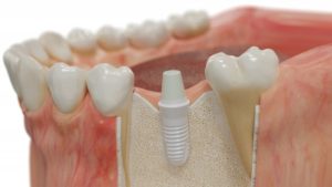 a ceramic dental implant