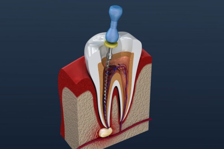 Do Root Canals Cause Cancer Myth Dr. William Twohig