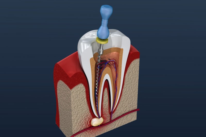 a digital image of a tooth undergoing a root canal in Weyauwega