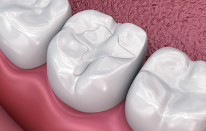 Illustration of tooth with tooth-colored filling