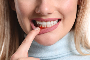 Woman pulling down lip showing inflamed gums