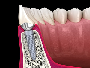 Illustration of dental implant in jawbone