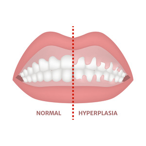 Illustration of smile with gingival hyperplasia